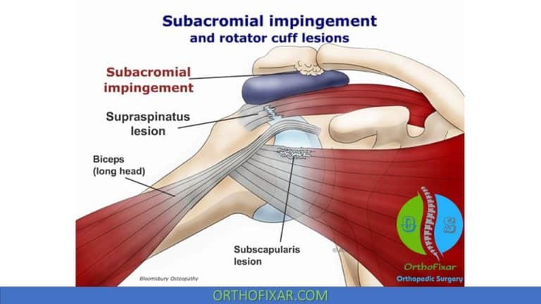 Hawkins Kennedy Test Of The Shoulder | OrthoFixar 2024