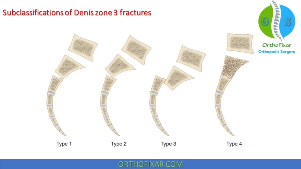 Roy-Camille and Strange-Vognsen and Lebech subclassifications of Denis zone 3 fractures