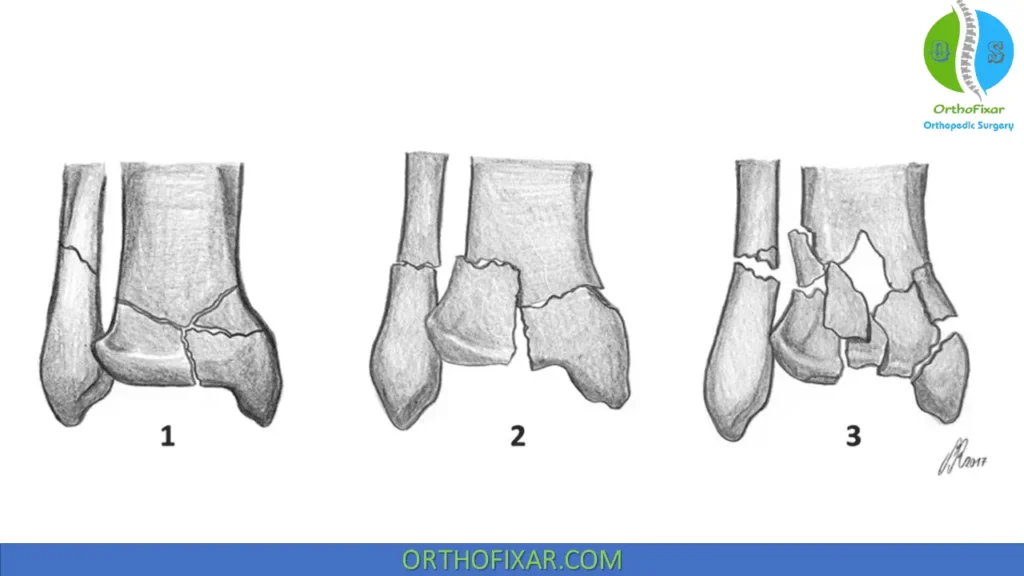 Ruedi and Allgower Classification of Pilon Fractures