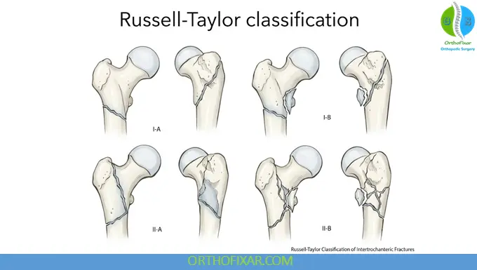 Russell-Taylor Classification Subtrochanteric Fractures