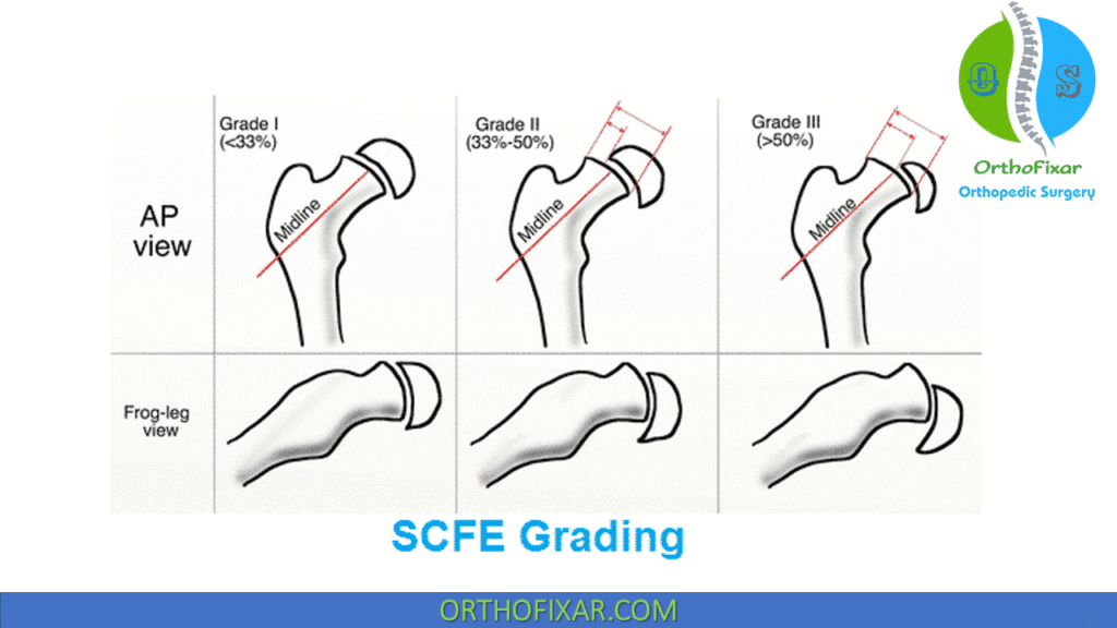 Slipped Capital Femoral Epiphysis | OrthoFixar 2025