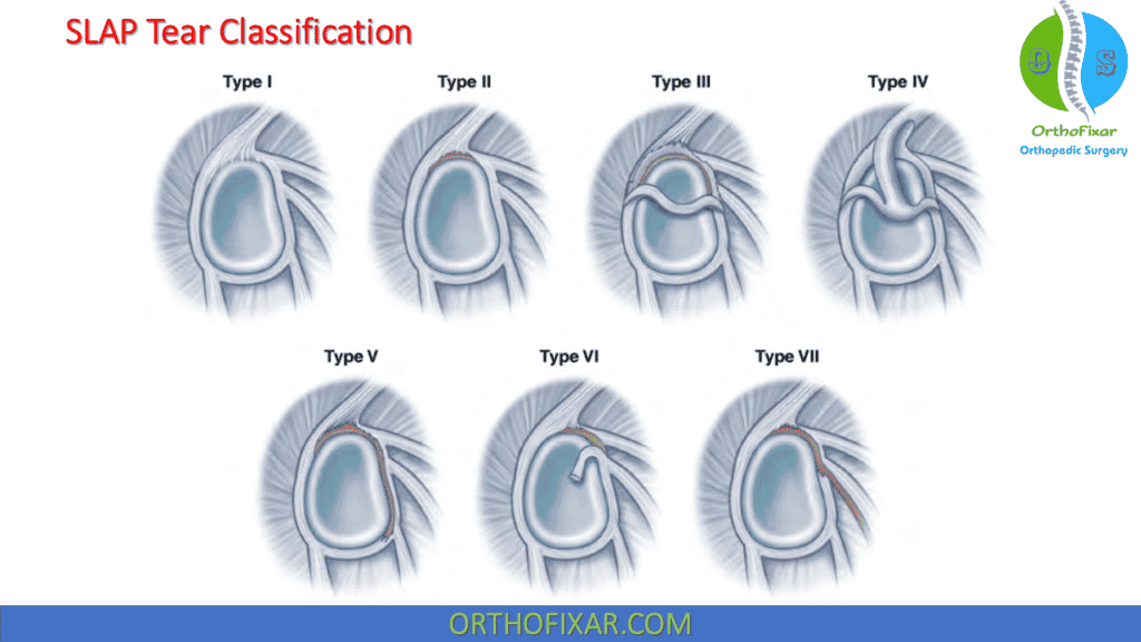 SLAP lesion Classification (Expanded Snyder classification)