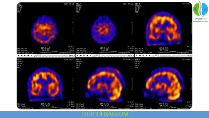 SPECT Scan Imaging: Principles, Uses & Clinical Applications 5 SPECT scan of brain