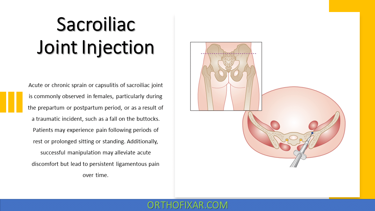  Sacroiliac Joint Injection 