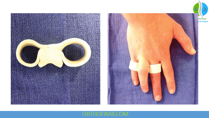 Sagittal Band Injury: Boxer’s Knuckle Symptoms & Treatment 7 Sagittal Band Injury splint