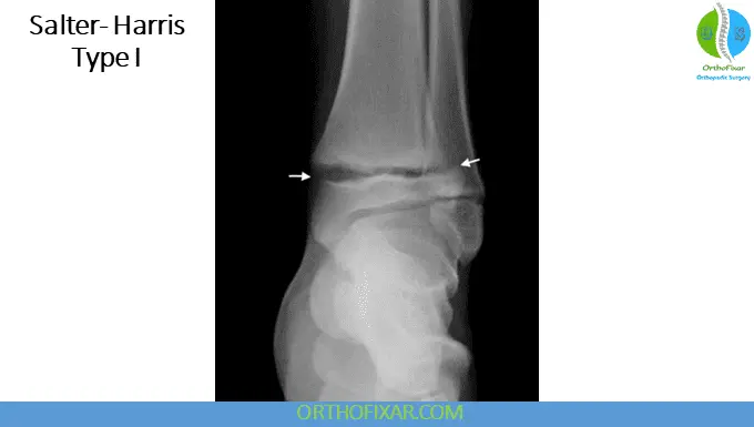 The 5 Salter Harris Fracture Types: Pediatric Physeal Injuries 13 Salter Harris Fracture Type 1