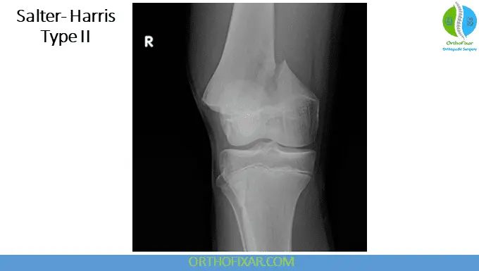 The 5 Salter Harris Fracture Types: Pediatric Physeal Injuries 14 Salter Harris Fracture Type 2