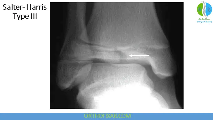 The 5 Salter Harris Fracture Types: Pediatric Physeal Injuries 15 Salter Harris Fracture Type 3