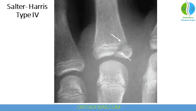The 5 Salter Harris Fracture Types: Pediatric Physeal Injuries 16 Salter Harris Fracture Type 4