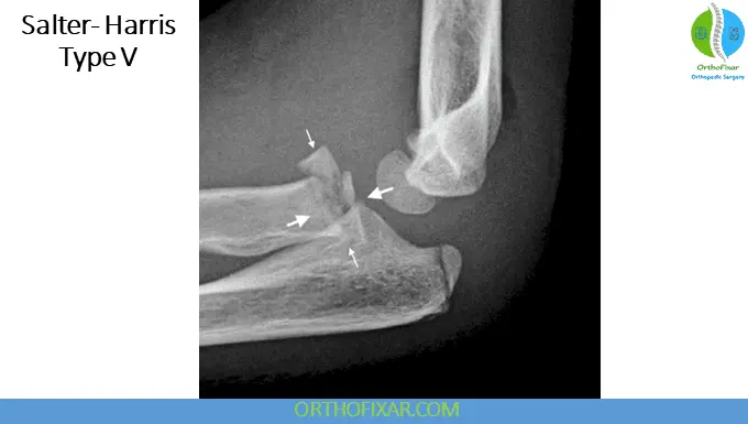 The 5 Salter Harris Fracture Types: Pediatric Physeal Injuries 17 Salter Harris Fracture Type 5