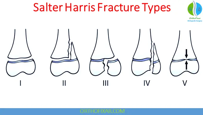 The 5 Salter Harris Fracture Types: Pediatric Physeal Injuries 12 Salter Harris Fracture Types