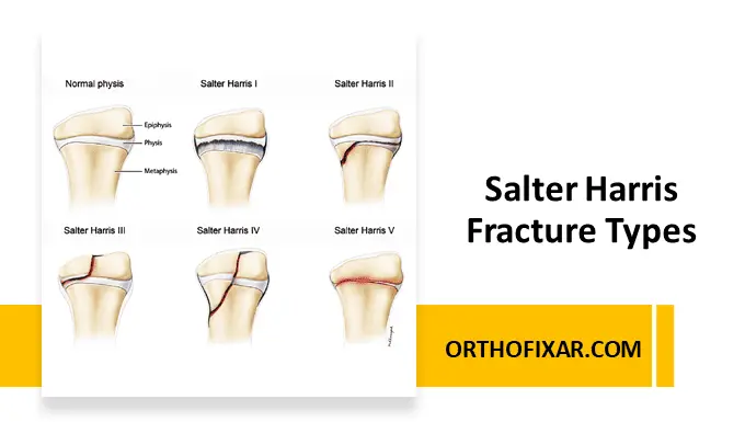 Salter Harris Fracture Types
