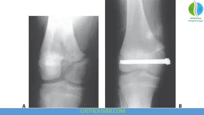 The 5 Salter Harris Fracture Types: Pediatric Physeal Injuries 19 Salter Harris Fracture treatment