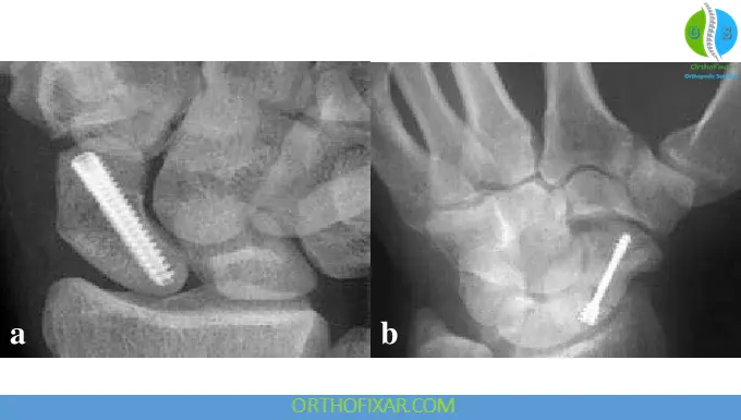Scaphoid Fracture treatment with screw fixation