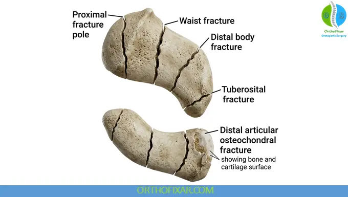 Scaphoid Fractures classification & types
