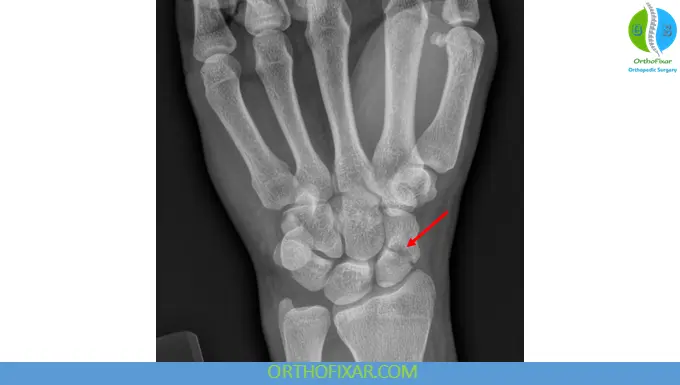 Scaphoid Fractures xray