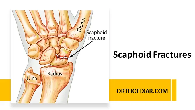 Scaphoid Fractures