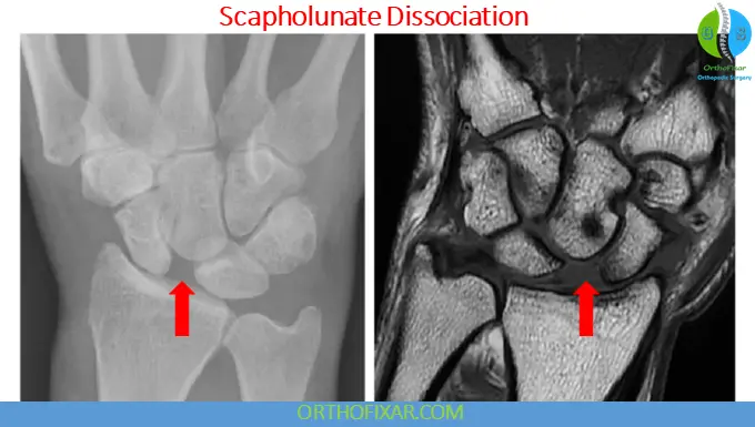 Scapholunate Dissociation imaging