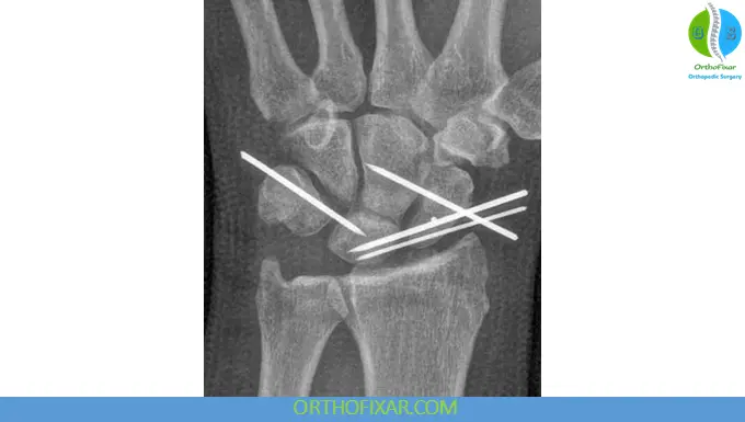 Scapholunate Dissociation orif with k-wires