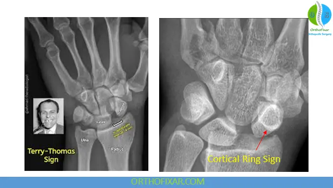 Scapholunate Dissociation signs