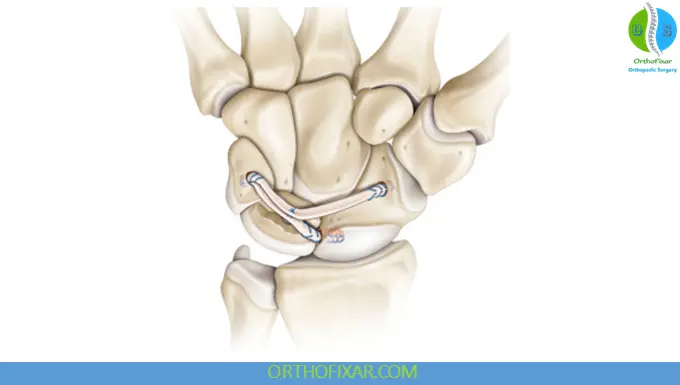 Scapholunate Dissociation tenodesis treatment