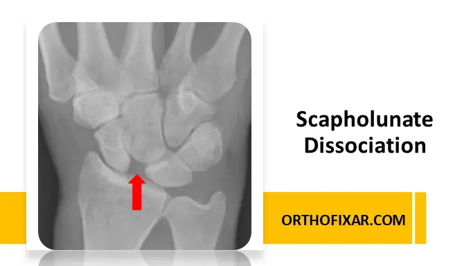 Scapholunate Dissociation