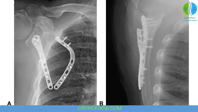 Scapula Fractures Treatment
