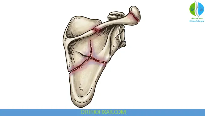 Scapula Fractures Zdravkovic & Damholt Classification