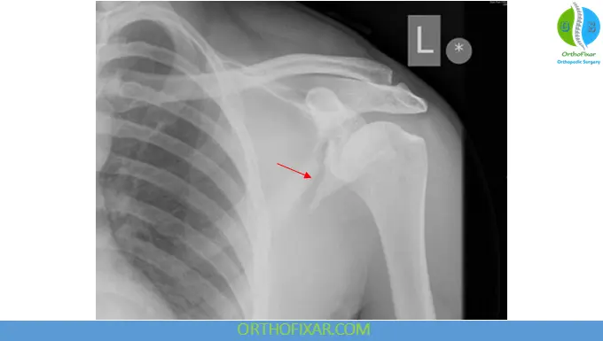 Scapula Fractures xray