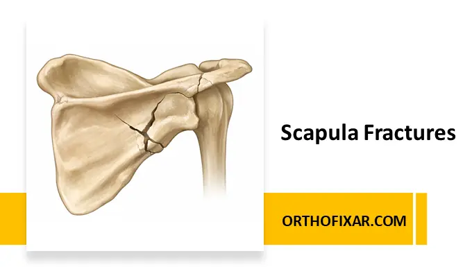 Scapula Fractures