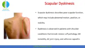 Scapular Dyskinesis