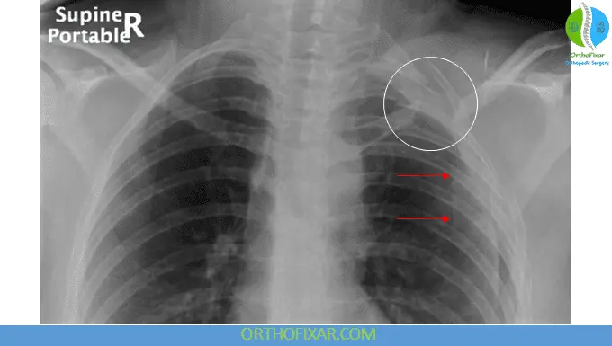 Scapulothoracic Dissociation xray