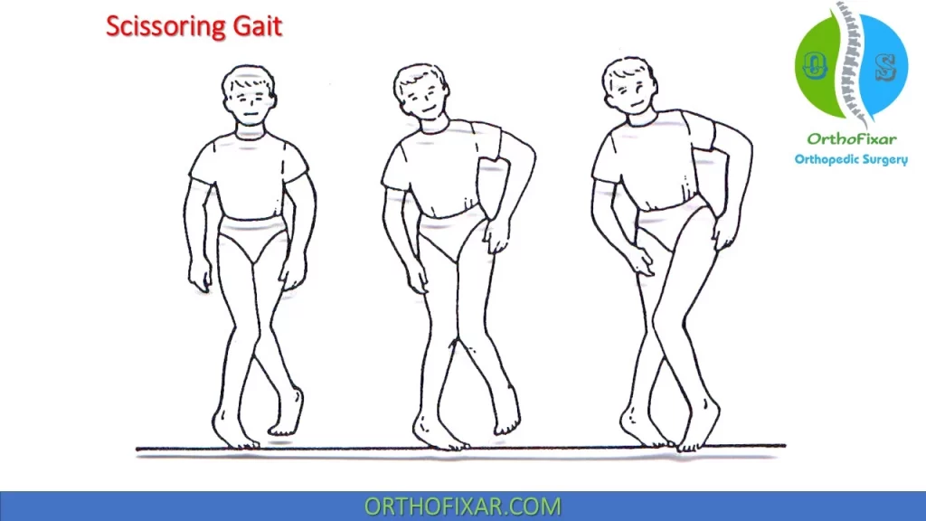 Scissoring gait