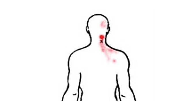 Semispinalis Capitis Muscle Pain 2 Semispinalis Capitis Muscle Pain location
