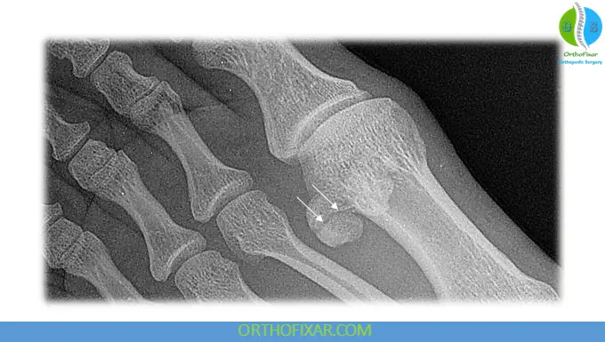 Sesamoid Fracture (broken sesamoid) 7 Sesamoid Fracture xray