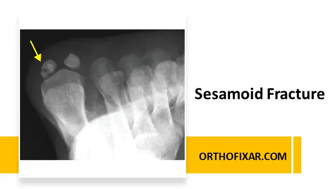 Sesamoid Fractures