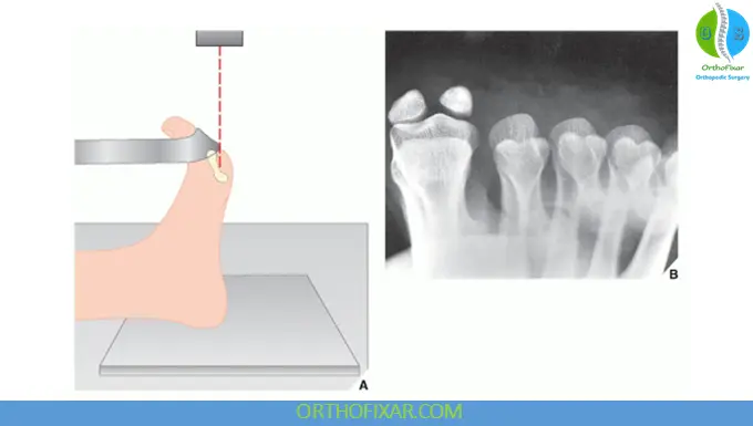 Sesamoid View (Tangential Projection)