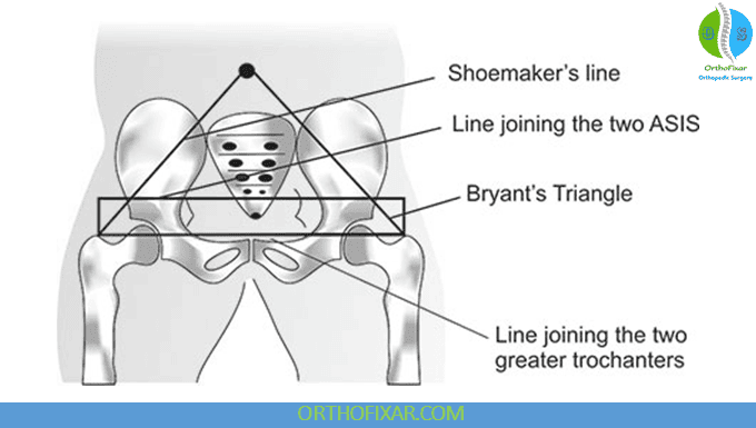 Hip Joint X-Ray Imaging 4 Shoemaker’s Line