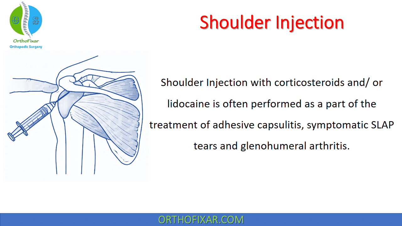 Shoulder Injection Posterior Approach