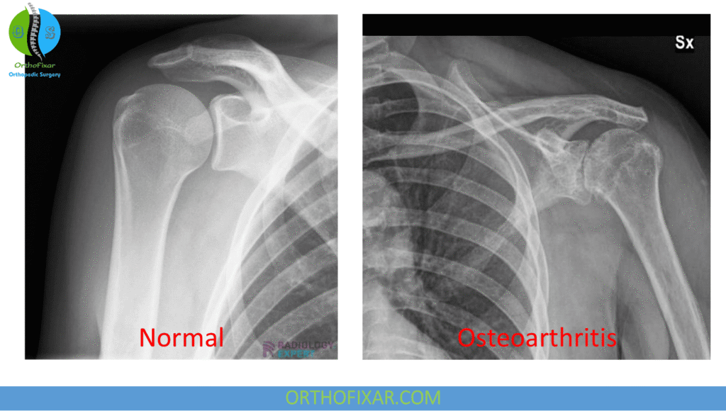 Shoulder Osteoarthritis