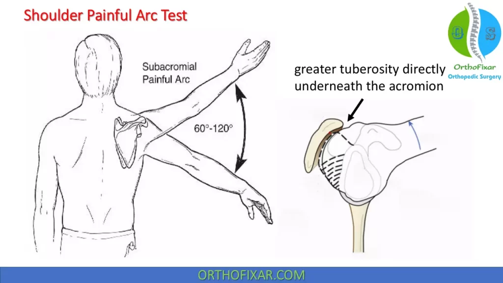 Shoulder Painful Arc Test Easily Explained OrthoFixar 2026 Shoulder Painful Arc Test Easily Explained OrthoFixar 2026