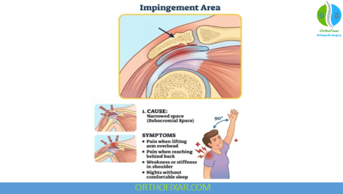 Shoulder Impingement: Symptoms, Tests, Exercises & Treatment 4 Shoulder impingement