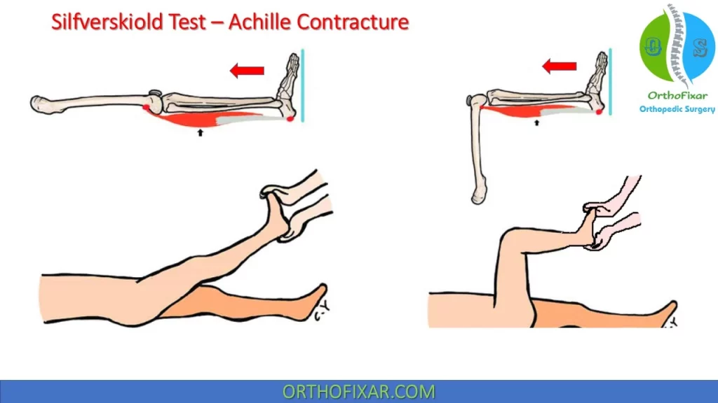 Silfverskiold Test – Achille Contracture