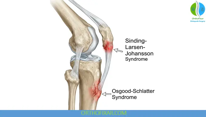 Sinding-Larsen-Johansson Syndrome VS Osgood-Schlatter disease