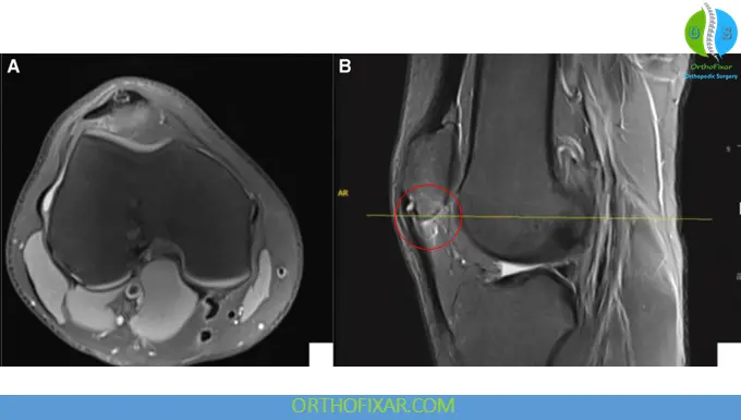 Sinding-Larsen-Johansson Syndrome mri