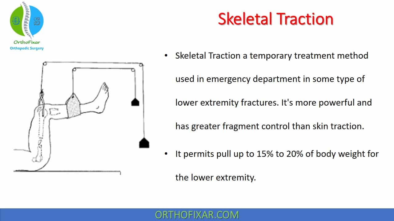 Skeletal Traction Types & Indications