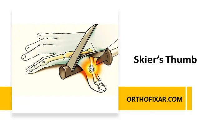 Skier’s Thumb