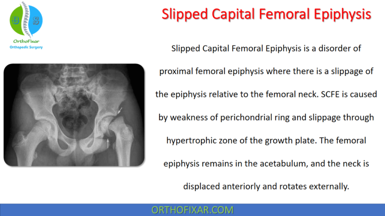 Slipped Capital Femoral Epiphysis