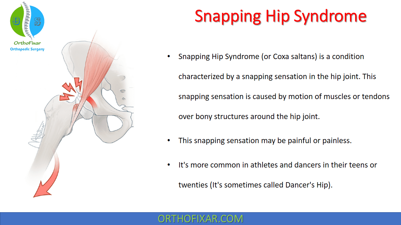  Snapping Hip Syndrome 