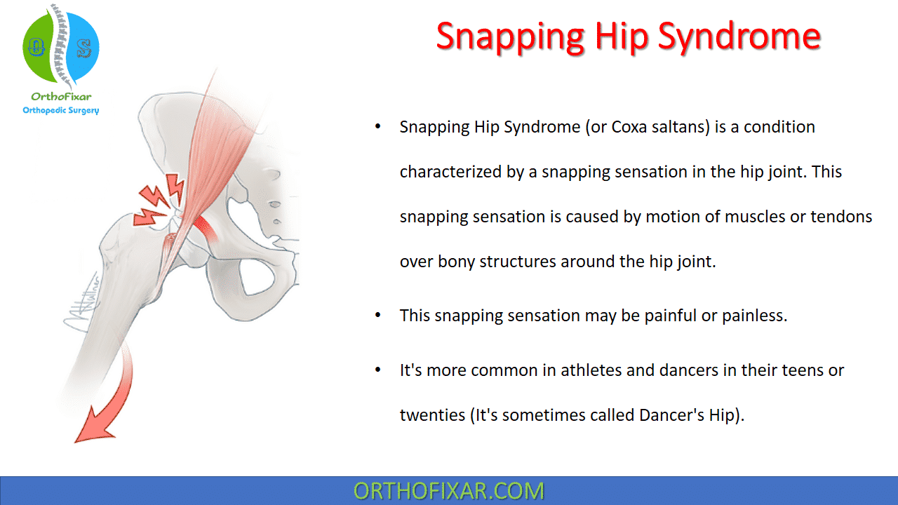 Snapping Hip Syndrome